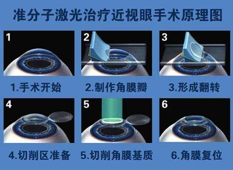 準分子激光只花了近視眼手術(shù)原理圖