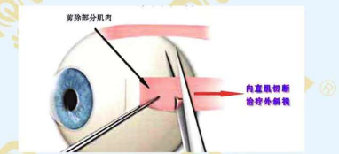  斜視手術(shù)需前需要滿(mǎn)足的條件
