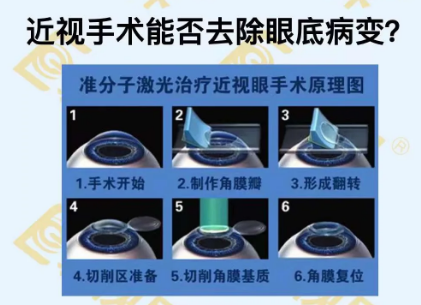 近視手術(shù)能否去除眼底病變？