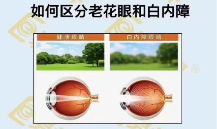 如何區(qū)分老花眼和白內(nèi)障？